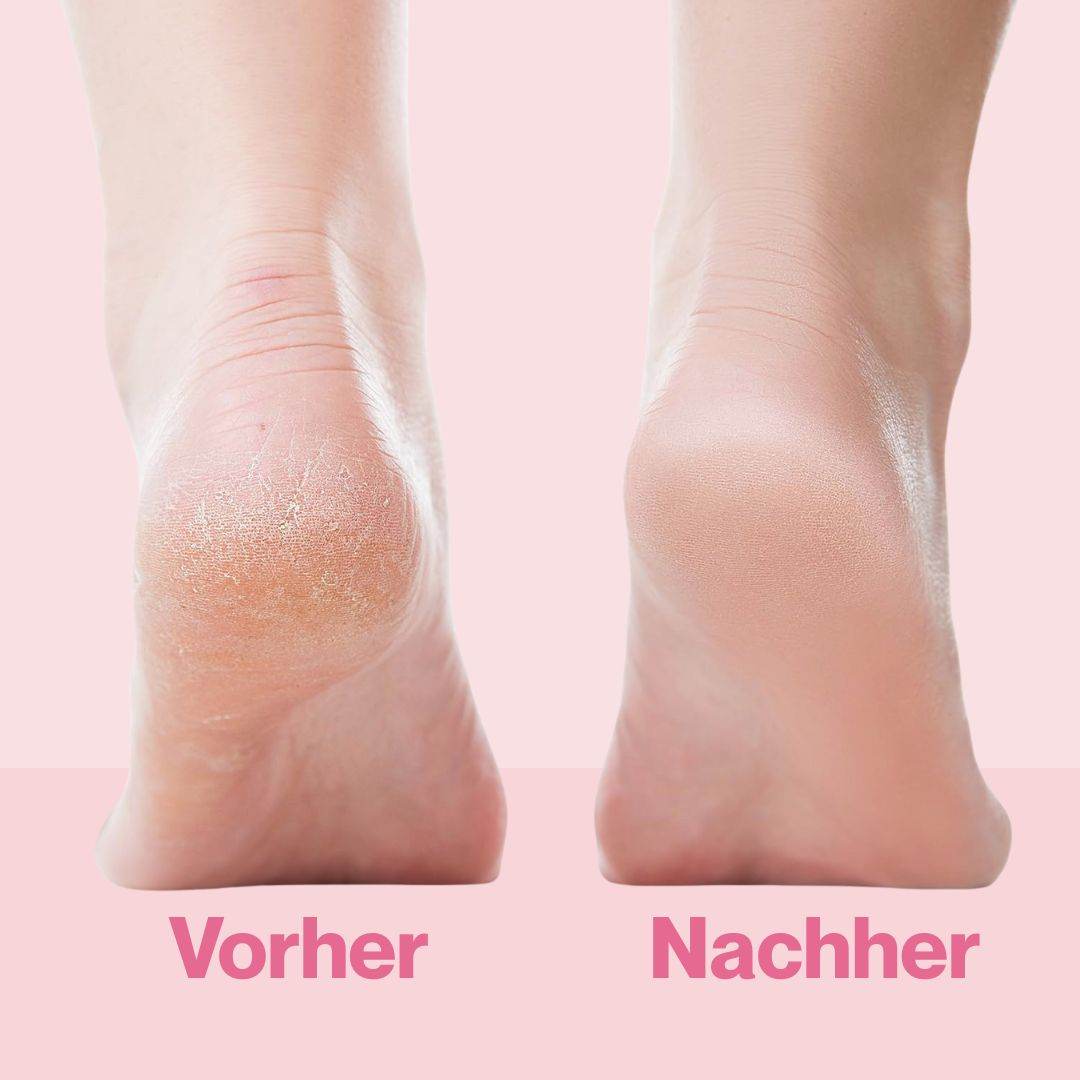 Betaya SmoothFeet - Premium Hornhautenferner-Set - Betaya
